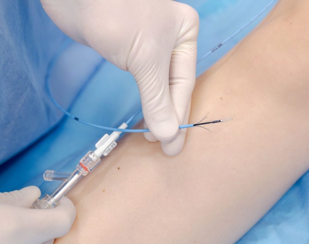 zylaki-skleroterapia-krakow-ultramed