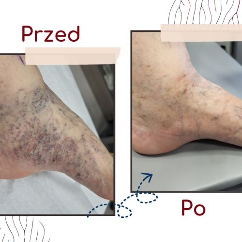 Ultramed_skleroterapia_efekty_Krakow