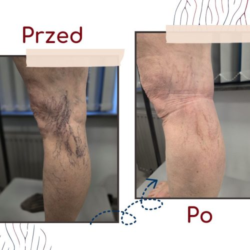 Ultramed_skleroterapia_przed_po_Krakow